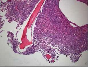 Figure 1: Low power slide which demonstrates hypercellular bone marrow comprised predominately of atypical promyelocytes.