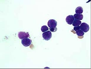 Figure 2: High power slide which demonstrates atypical promyelocytes.